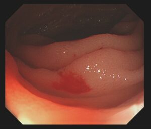 Obscure-Gastrointestinal-Bleeding-1.jpg