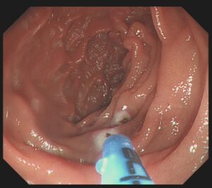 Obscure-Gastrointestinal-Bleeding-2.jpg